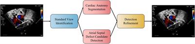 Automatic Detection of Secundum Atrial Septal Defect in Children Based on Color Doppler Echocardiographic Images Using Convolutional Neural Networks